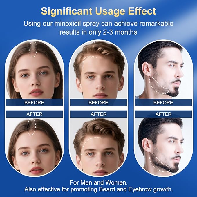 5% Minoxidil for Men & Women - Hair Growth Serum & Hair Regrowth Treatment | Extra Strength with Biotin | 6-Month Supply 4-Pack (14 fl oz) | Clinically Proven for Hair Loss & beard growth