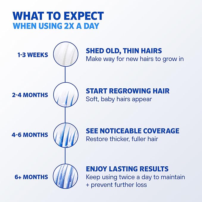 Men’s Rogaine Extra Strength 5% Minoxidil, Topical Solution for Thinning & Hair Loss, Clinically Proven FDA Approved Minoxidil for Men Treatment, Regrow Fuller Hair, 3 Month Supply, 3 Bottles