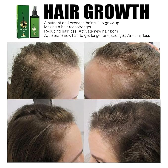 Ginger Hair Growth Serum with Ginger Oil - Anti Hair Loss Treatment, Promotes Thicker, Fuller and Faster Growing Hair (4 FL OZ) (1 Pcs)