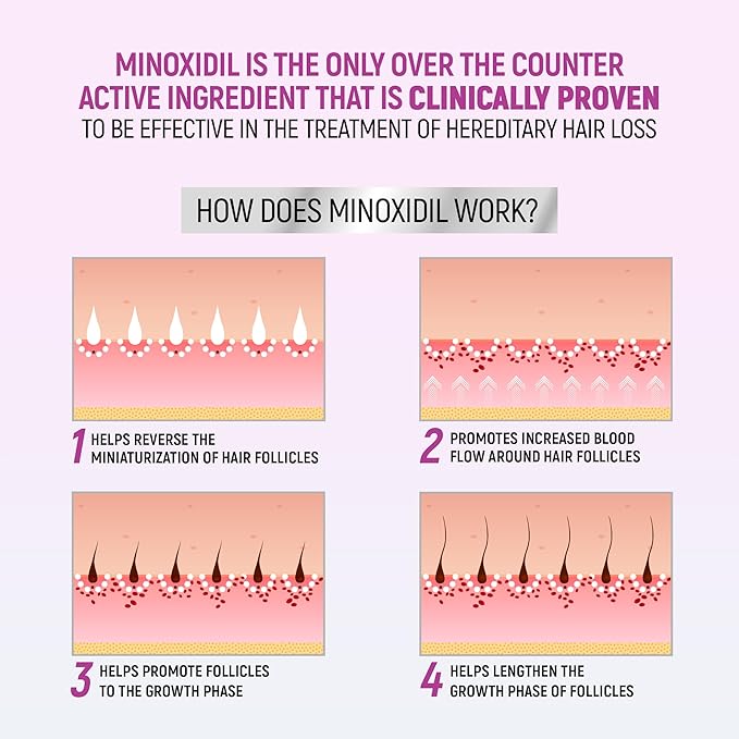 Minoxidil for Women, 2.11 Oz (2 Months Supply) Clinically Proven to Regrow Hair, Topical Aerosol Foam 5%, Hair Thinning Treatment