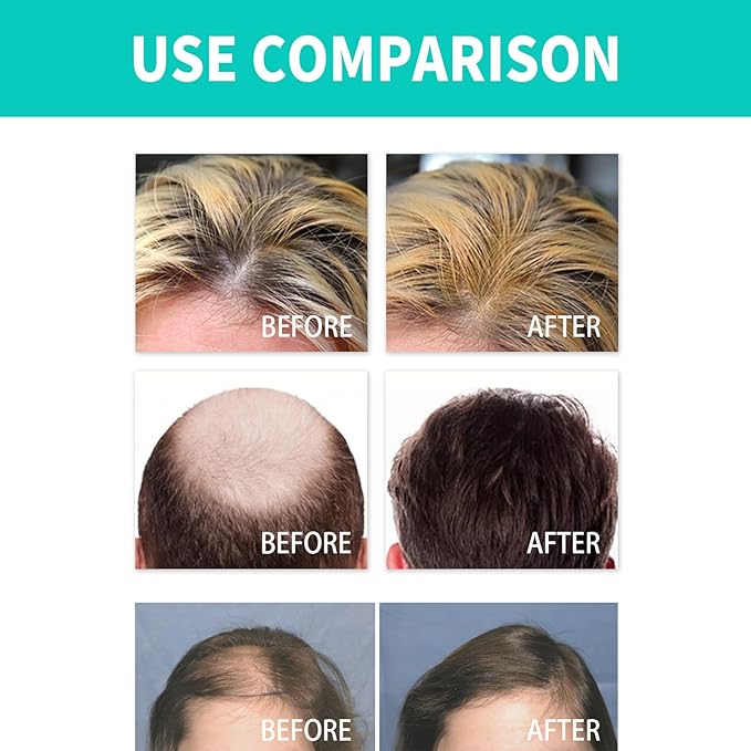 18ml Hair Regrowth Roll-On Serum Scalp care for thinning hair and hair loss concerns Natural ingredient formula - Hair regeneration - Density enhancement - Suitable for both men and women