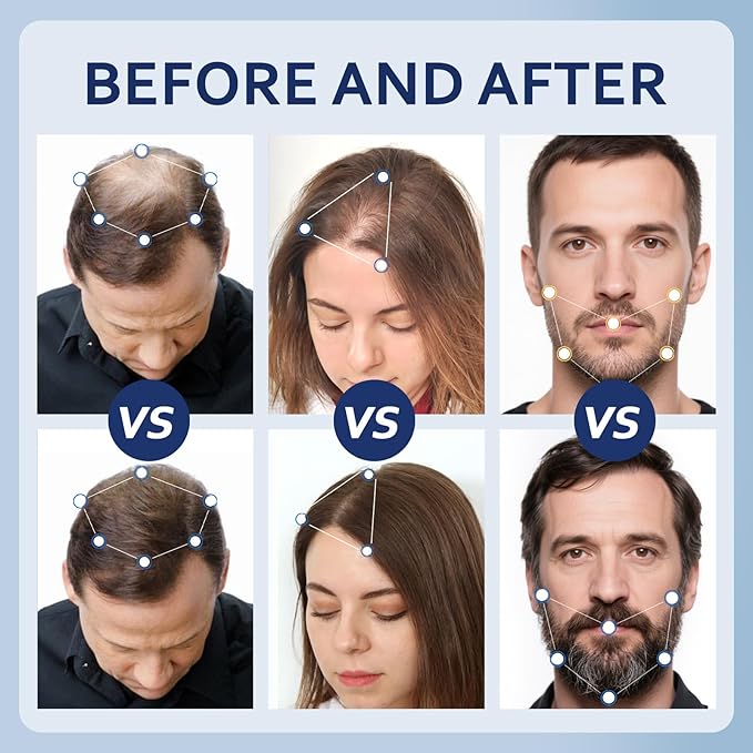 5% Minoxidil Hair Growth Serum for Men & Women with Biotin: Minoxidil for Men and Women, 5 Percent, Hair Regrowth Treatment, Extra Strength (8 FL OZ, Dropper 4)