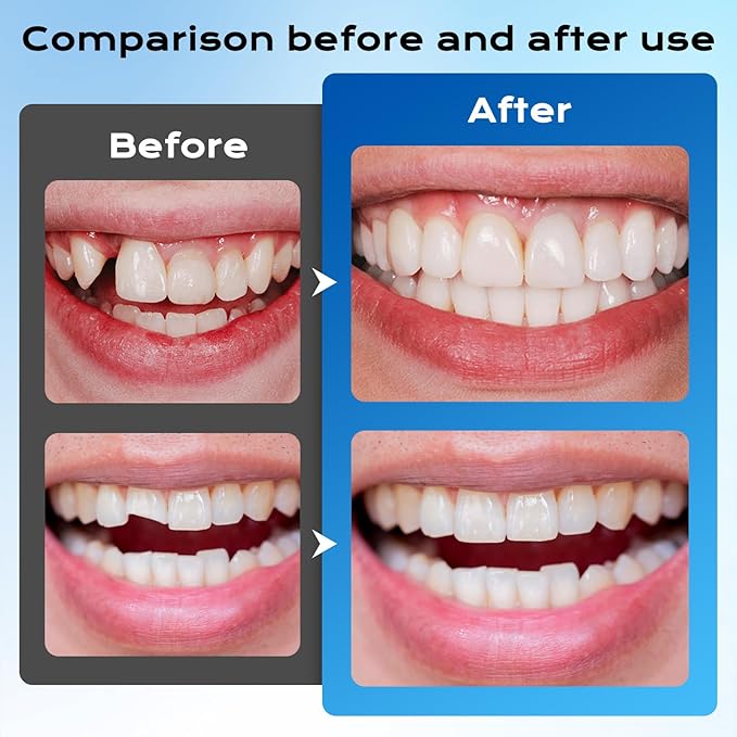 Tooth Repair Kit，Moldable Beads Instant Fix for Confident Smiles-30ML-N1