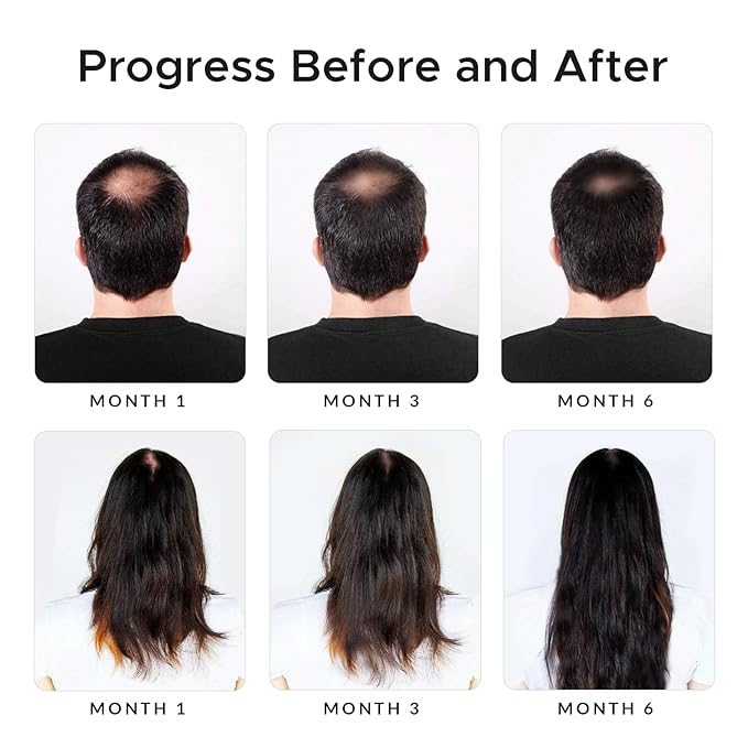 Minoxidil & Biotin Shampoo for Hair Growth - Enriched with Caffeine, Castor Oil & Onion - DHT Blocker for Thicker, Healthier Hair - Strengthening Formula for Men & Women