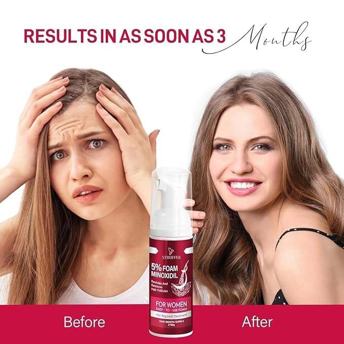 5% Minoxidil Foam for Women: Hair Regrowth Treatment for Thinning Hair and Hair Loss, Lightweight Non-Greasy Formula, Dermatologist Recommended, 2 × 60g (2-Month Supply)