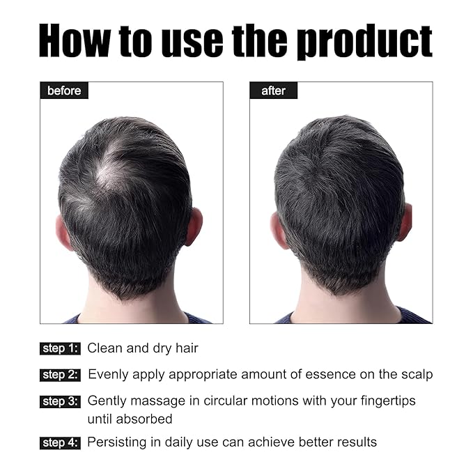 30ml Men's Hair Growth Oil for Thinning Hair – Hair Regrowth Treatment for Balding & Receding Hairline, Natural Hair Thickening Serum with Rosemary & Ginseng
