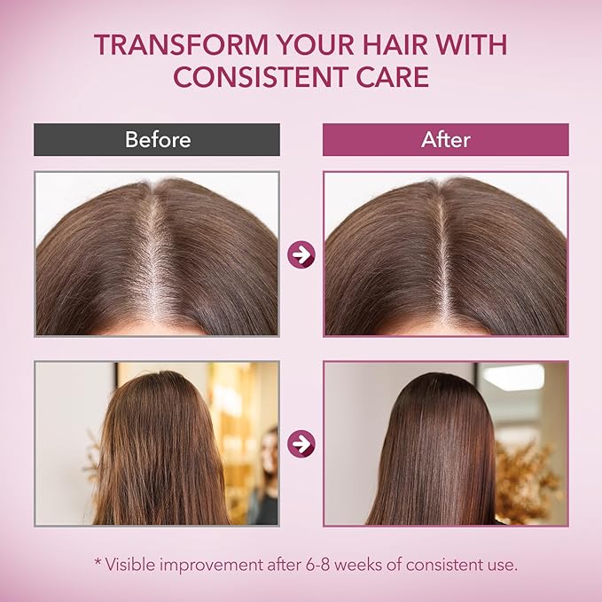 Onion & Rosemary Hair Growth Shampoo: Biotin Infused Shampoo for Hair Loss and Thinning Hair - Promotes Healthier, Thicker and Stronger Hair for Women and Men (16.9 Fl Oz (Pack of 1)) | Shampoo, for Hair Loss, and Thinning Hair, Promotes Healthier, Thi...