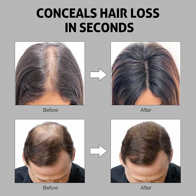 Ustar Hair Building Fibers for Thinning Hair 12g Conceals Hair Loss Instantly Thicker Fuller Natural Look 9 Shades for Women & Men (Medium Brown)