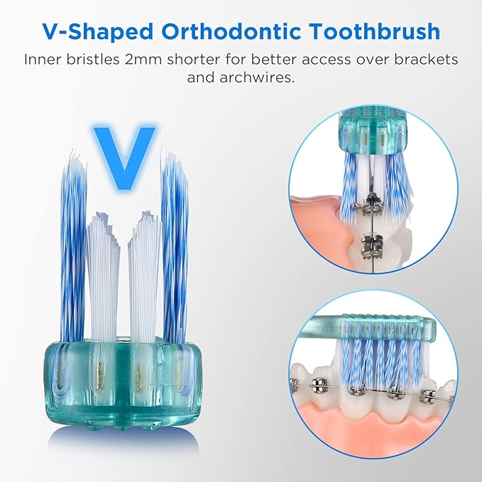 Fregum V-Shaped Orthodontic Toothbrush for Braces, Soft Bristles, 6 Count, No Interdental Brushes Included