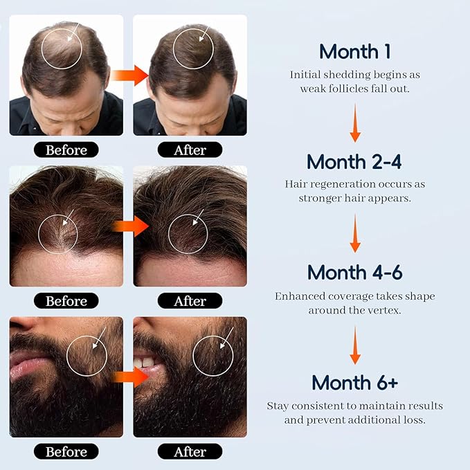 5% Minoxidil for Men and Women, Hair & Beard Growth Treatment with Biotin & Rosemary Growth Treatment for Thinning & Hair Loss - Extra Strength Minoxidil Hair Loss Serum 4 oz