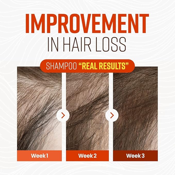CRAZY SKIN German Beers Yeast Biotin Shampoo for Anti-hair loss, and Thickening,Gentle Exfoliating & Scalp Function with Panthenol, Collagen and Free-Sulfate, limescale removal, 300ml(10.15oz)