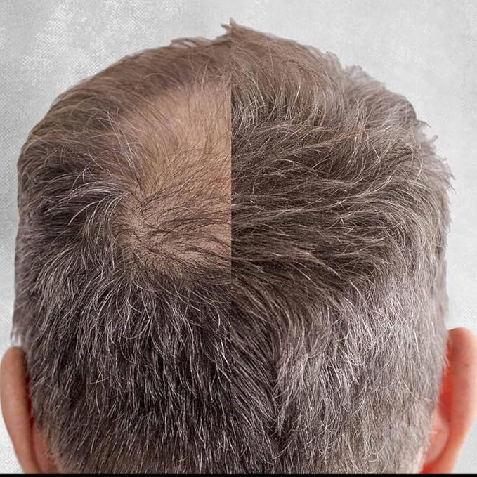 Hair Building Fibers, 28g - for Thinning Hair Instantly Thicker, Complete Looking Hair 6 Shades for Men Women (Dark Brown)
