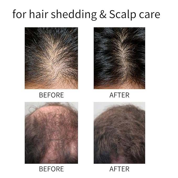 5% Minoxidil Hair Growth Serum Spray for Men & Women, Hair and Scalp Regrowth Treatment, Hair Loss Prevention & Hair Thickening Support