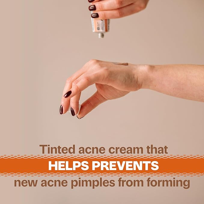 Adult Acnomel Acne Medication Cream, 1.3 Ounces