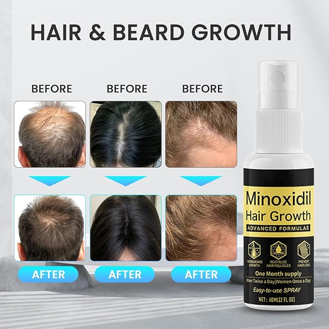 5% Minoxidil for Men & Women, Minoxidil Hair Growth for Women,Hair Growth Treatment for Thicker Longer -Advanced Formula Hair Regrowth Spray and Topical Solution for Thinning Hair and Beard 3 pack