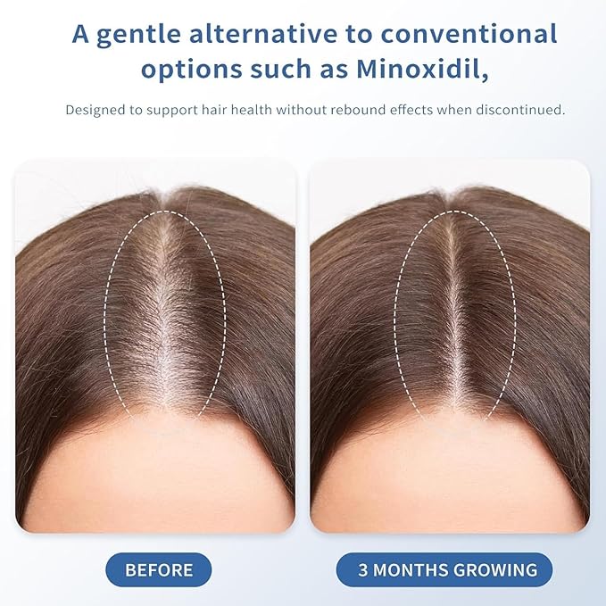 Hair Growth Serum Roll-On for Thinning Hair – Stimulates Follicles, Strengthens Roots & Boosts Density with Rosemary & Biotin – Non-Greasy Scalp Treatment for Men and Women 30ml