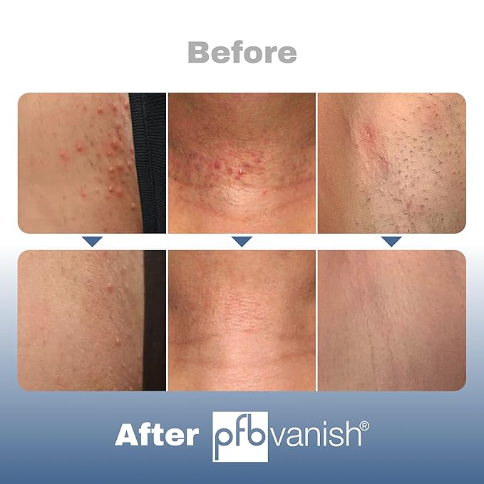 PFB Vanish Razor Bump Stopper Roll On Shaving Gel - Skin Care Treatment for Ingrown Hairs and Razor Burns, 93g