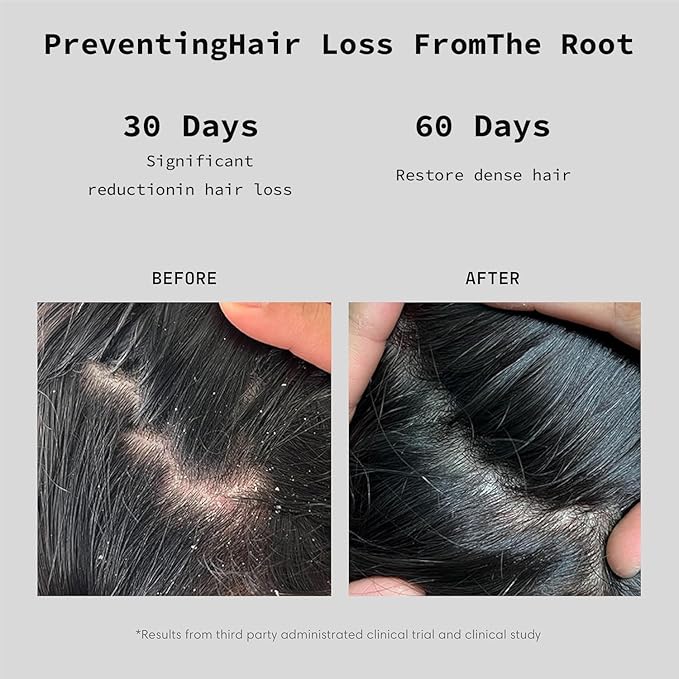 Rosemary Biotin Shampoo，Thickening Shampoo with Amino Acids for Hair Loss，Dandruff Control & Oily Scalp，Vegan, for Women & Men (Standard, Rosemary)