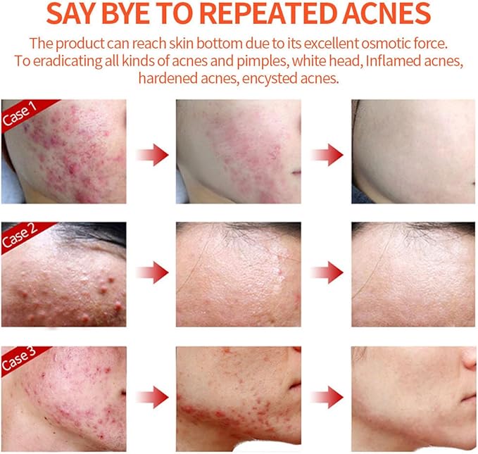Acne Cream Pimple Cream for Face, Oil Control Pimple Remover Cream Get Rid of Pimples Fast,for Oily and Acne Prone Skin, Cruelty Free, Crema para espinillas en la cara