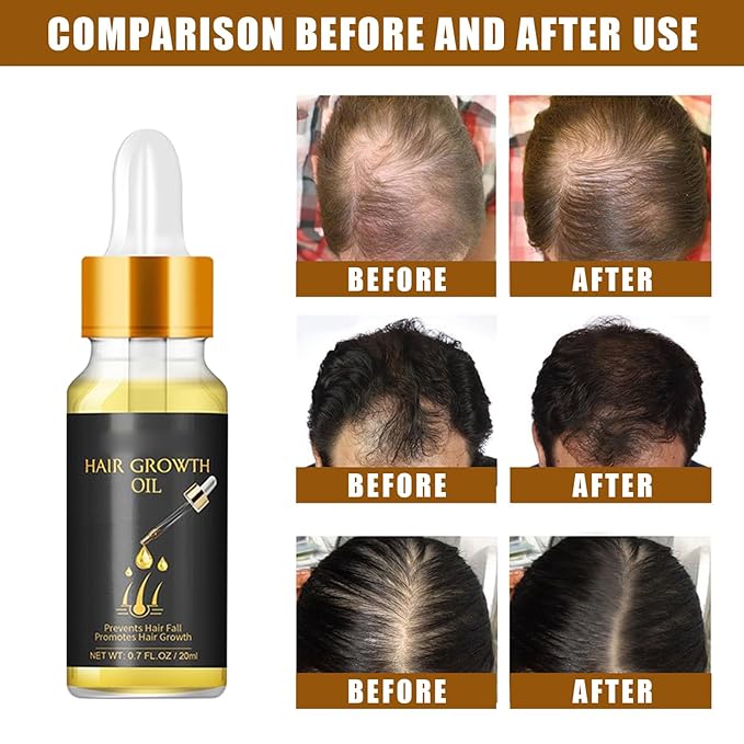 20ml Hair Growth Oil for Thinning Hair – Stimulates Hair Regrowth, Reduces Hair Fall & Boosts Volume with Rosemary & Ginger Extract