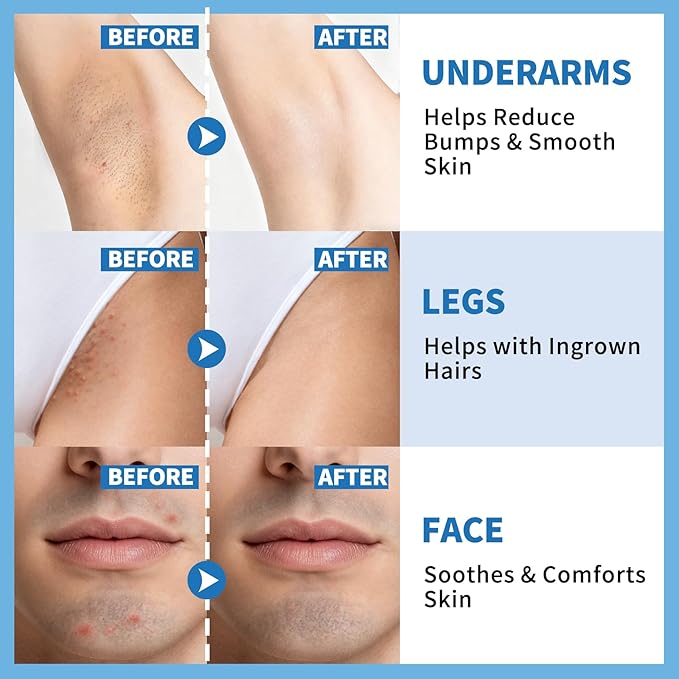 dewyhour Ingrown Hair & After Shave Soothing Serum–Soothes Razor Irritation, Targets Dark Spots,Helps With Razor Bumps for Face,Underarms,Neck & Bikini Area,Korean Skincare Roll-On for Men & Women