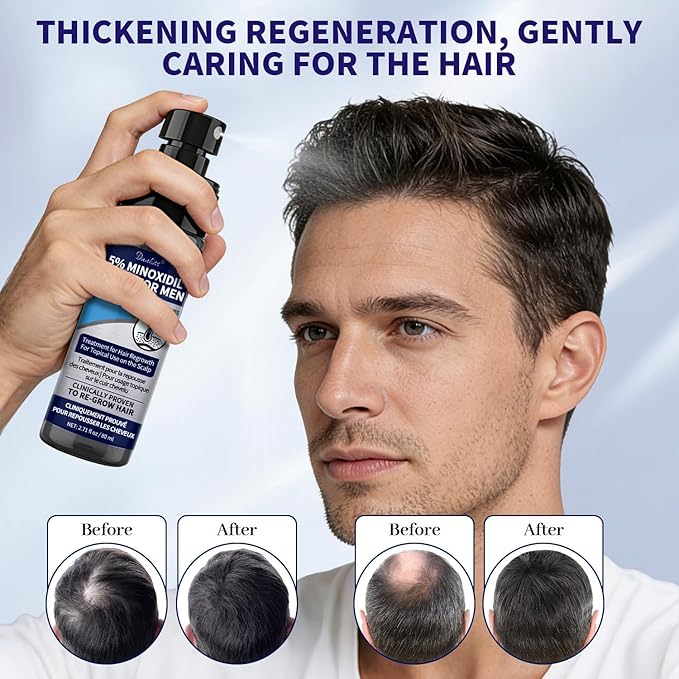Minoxidil for Men & Hair Minoxidi with 5% Minoxidil Biotin and Rosemary & for Hair Beard Regrowth Treatments Extra Strength Hair Loss Solution, Total 160 ml / 5.42 fl oz for 3 Months (Pack of 2)