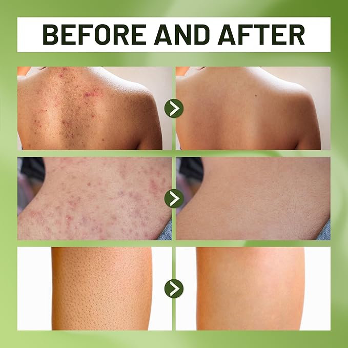 ABERA Folliculitis Shower Gel, High-Performance BHA Body Wash, Wild Bitter Melon Extract, 1 Box + Eye Roller Serum | Eye Bags, Dark Circles & Puffiness Treatment | Mint Essence with Vit C & Peptides
