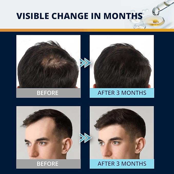 5% Minoxidil Hair and Beard Growth Kit: Extra Strength Minoxidil Topical Hair Regrowth Treatments Serum for Thinning Hair - Hair Loss Products for Men and Women