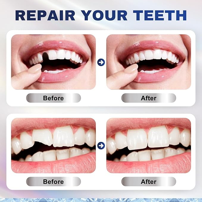 Tooth Repair Kit，Moldable Beads for Instant Teeth Fix & Confidence Boost (1 Count (Pack of 1))