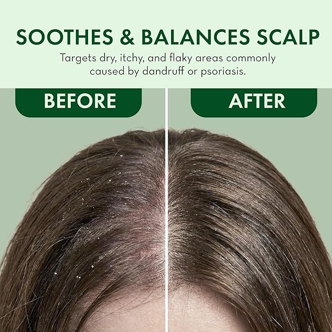 Leave In Conditioner Spray - Rosemary & Mint Scalp Treatment - Anti-Dandruff and Dry & Itchy Scalp treatment, Hydrating & Medicated Formula for Psoriasis and Scalp Care - Detangles & Nourishes Hair.