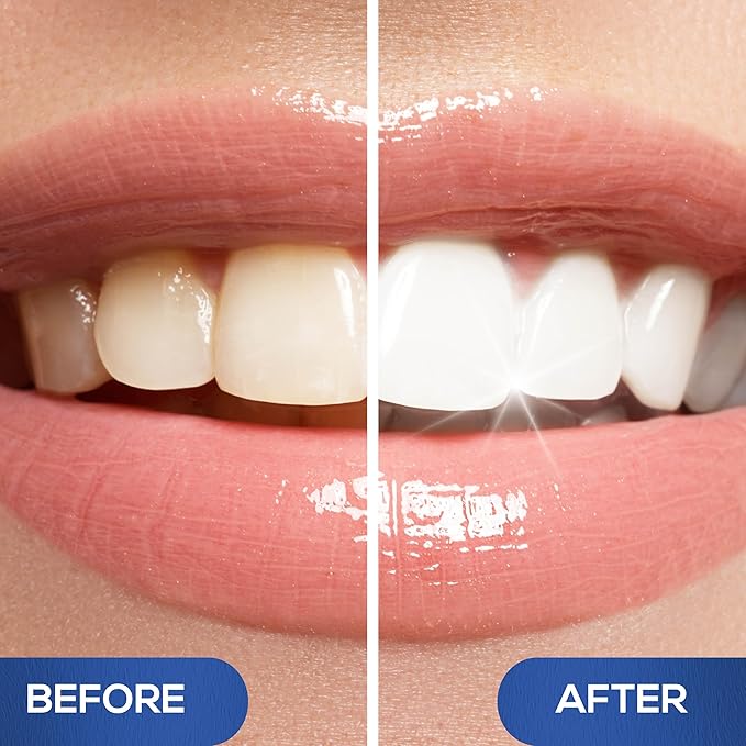 Venus Visage Award Winning Teeth Whitening Pen, 10+ Uses - Teeth whitening Gel Professionally formulated - Best Teeth whitening kit Teeth Whitener - Low Sensitivity - Mint - 0.07 Fl Oz (Pack of 1)