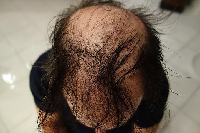 Finally Hair Fibers for Thinning Hair - 100% Undetectable Natural Formula - Completely Conceals Hair Loss in 15 Seconds - 25 Grams Refill Bag (Dark Brown)
