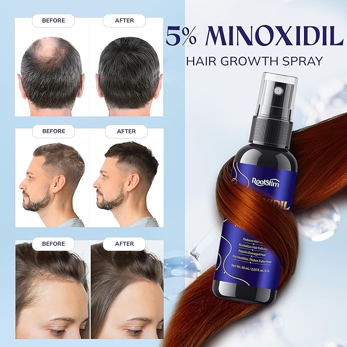 5% Minoxidil Hair Growth for Men and Women: Extra Strength Minoxidil Kit Hair Loss Treatment Serum with Rosemary for Faster Stronger Thicker Hair Growth 2 Fl Oz