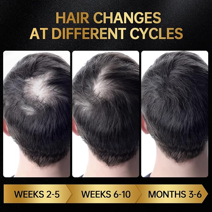 Minoxidil for Men & Women, With Biotin, Batana Oil, Rosemary Essential Oil, Effective Hair Loss Solution, Hair Loss Treatment for Hair Regrowth, Non-Greasy 5% Minoxidil - 60ml(Serum + Massager Set)