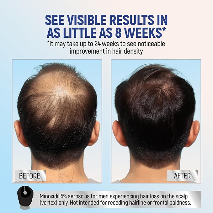 Minoxidil Topical Aerosol Foam, 5%, Hair Regrowth 4 Months Treatment for Men, 2.11 oz (4 Pack)