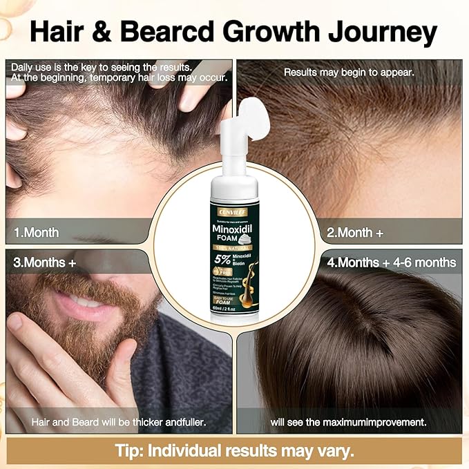 5% Minoxidil Foam for Men and Women Hair Growth, Slows Hair Loss and Promotes Hair Regrowth Treatment for Women and Men, Thicker Hair(2.11oz Pack of 1)