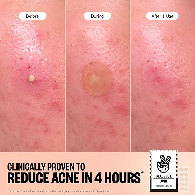 PEACE OUT Acne Healing Dots Helps Clear Blemishes Overnight, Fast Acting Hydrocolloid Pimple Patches for Breakouts with Salicylic Acid, Retinol and Aloe Vera, Award Winning Skincare Solution 20 Count