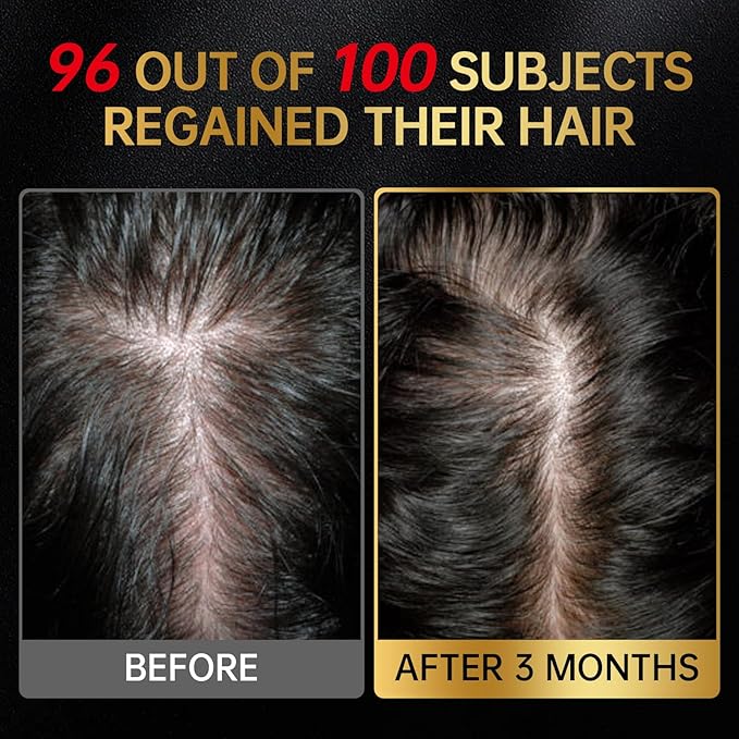Minoxidil for Men & Women, With Biotin, Batana Oil, Rosemary Essential Oil, Effective Hair Loss Solution, Hair Loss Treatment for Hair Regrowth, Non-Greasy 5% Minoxidil - 60ml(Serum + Massager Set)