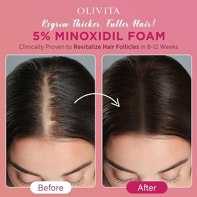 5% Minoxidil Foam for Women Hair Growth: OLIVITA Spray Hair Regrowth Treatment Serum with Biotin & Rosemary -Stop Hair Thinning and Hair Loss For Stronger Thicker Longer Hair 3 Packs