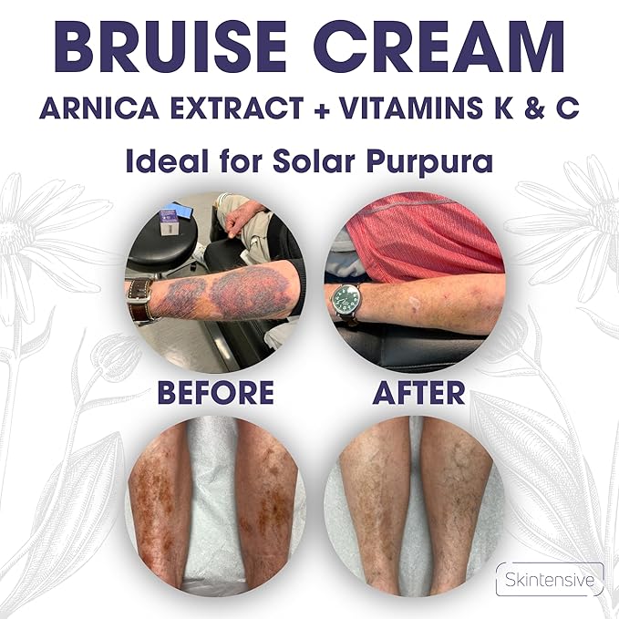 SKINTENSIVE Arnica Bruise Cream for Thin Skin - Moisturizing Arnica Cream, Vitamin K C and E, Skin Renewal, 4 Oz