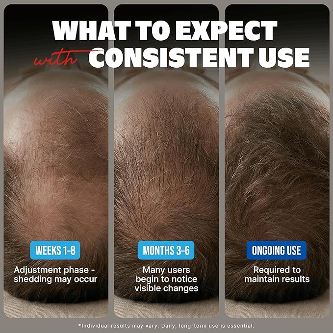 Minoxidil Liquid Extra Strength Hair Regrowth Treatment for Men, 5% Topical Solution, 6 Months Supply - Dropper Applicator and Bonus Free Instructional Guide Included