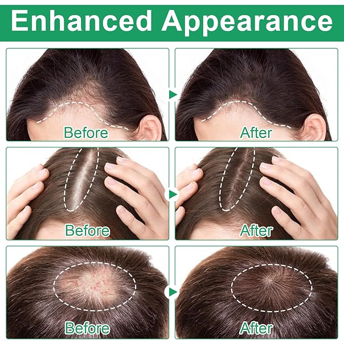 Rosemary Hair Growth Serum Roll On 20 ml – 3% Rosemary, 3% Redensyl, 2% AnaGain, Fast-Absorbing, Non-Greasy, Reduces Hair Fall, For Thinning Hair & All Hair Types (1)