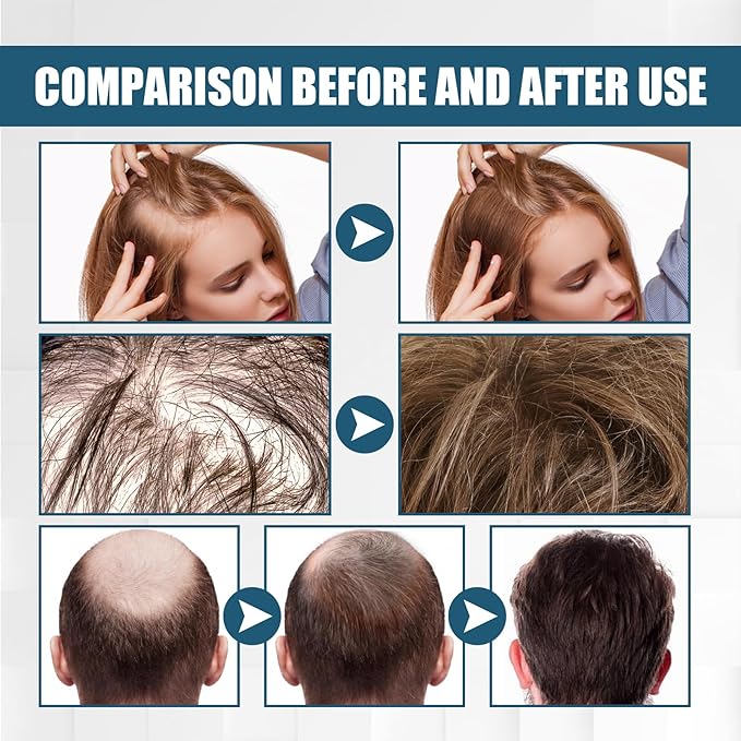 50ml Hair Growth Spray for Thinning Hair – Natural DHT Blocker with Ginseng & Biotin to Reduce Hair Loss, Stimulate Follicles & Regrow Fuller, Thicker Hair