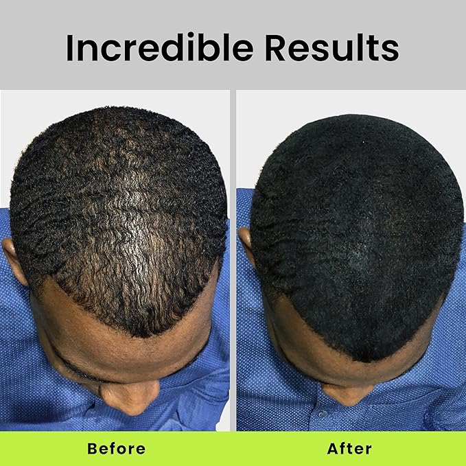ECLIPSE Hair Fibers Dark Blonde for Thinning Hair for Women & Men to Conceal Hair Loss in 15 Seconds - 100% Undetectable Hair Building Fibers, 30g