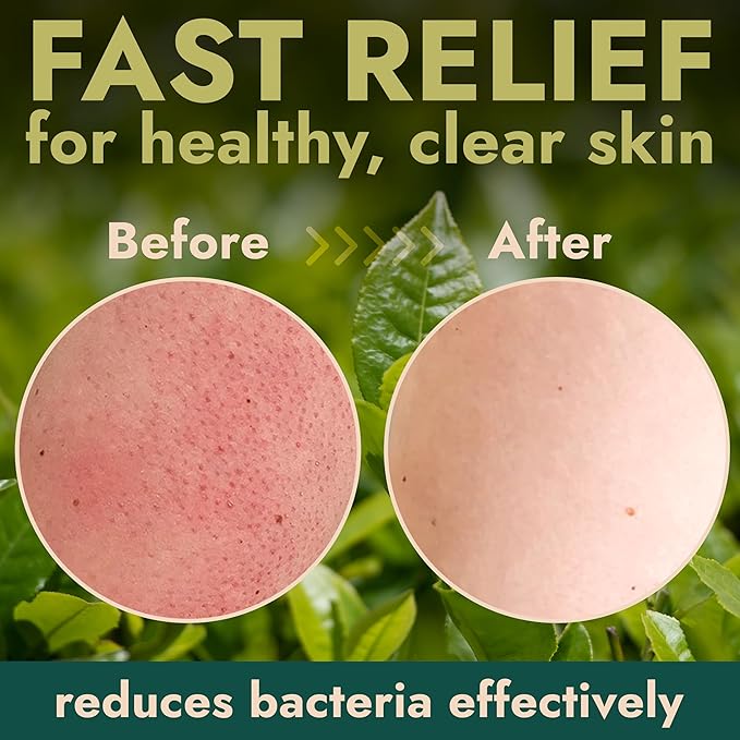 Antibacterial Body Scrub | Manuka Honey & Charcoal | Kills 99.9% of Germs & Bacteria | Body Scrub Exfoliator Deep Cleansing & Purifying for Smooth, Fresh & Soft Skin | 16 fl oz