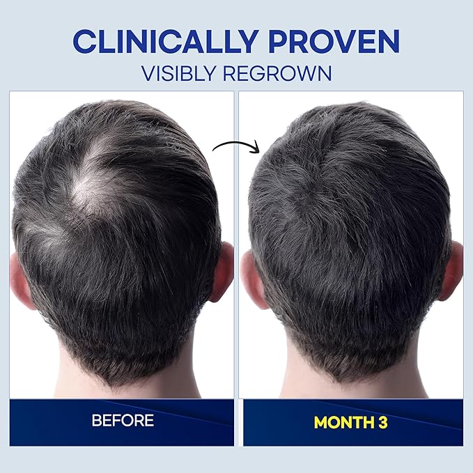 Minoxidil Hair Growth Treatment for Men: Clinically Proven 5% Minoxidil Treatment for Hair Loss & Thinning - Extra Strength Hair Regrowth Treatment & Scalp Nourishment - Made in USA - 2 FL OZ