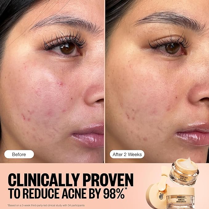 PEACE OUT Acne Gel Moisturizer for Oily Skin, Face Cream for Acne-Prone Skin with 2% Salicylic Acid, Niacinamide and Ceramides, 1.69 fl oz