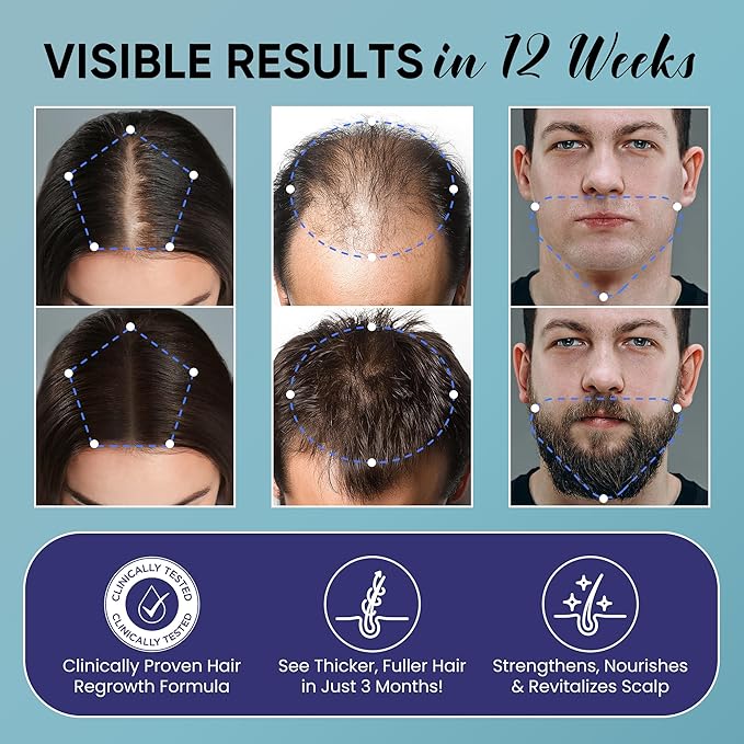 5% Minoxidil for Men and Women Hair Growth Kit: Minoxidil Spray Hair Regrowth Treatment Serum with Biotin & Rosemary -Stop Hair Thinning and Hair Loss For Stronger Thicker Longer Hair 2 Pack
