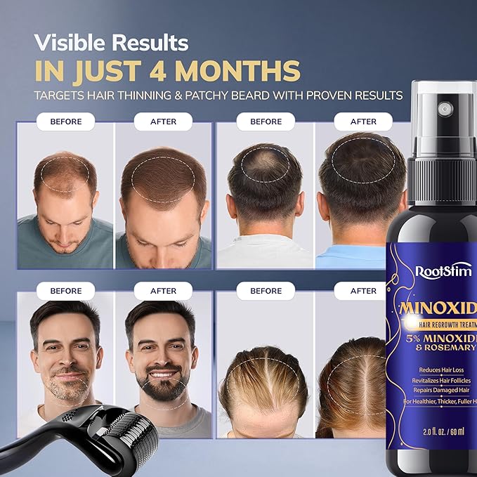 5% Minoxidil Hair Grouth Kit for Men and Women with 0.25 mm Skin Roller – Hair Regrowth Spray & Beard Growth Kit – Targets Thinning Hairlines, Crowns & Patchy Beards – Non-Greasy, Fast-Drying 60ML