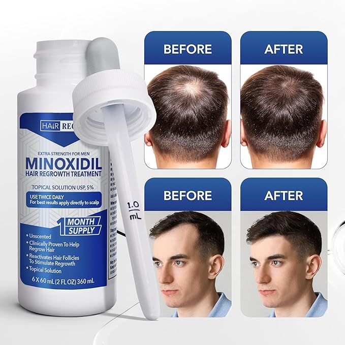 Liquid Minoxidil for Men 5% – Advanced Topical Solution for Regrowth – Growth Treatment for Men Hair Loss 6-Pack as 6-Month Supply Kit